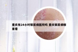 重庆有24小时银屑病医院吗 重庆银屑病哪里看