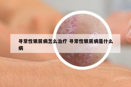 寻常性银屑病怎么治疗 寻常性银屑病是什么病