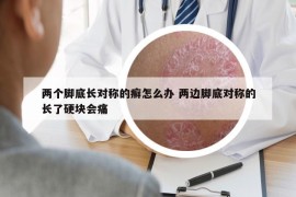 两个脚底长对称的癣怎么办 两边脚底对称的长了硬块会痛