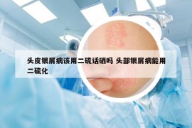 头皮银屑病该用二硫话硒吗 头部银屑病能用二硫化