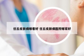 任丘皮肤病哪看好 任丘皮肤病医院哪家好