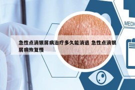 急性点滴银屑病治疗多久能消退 急性点滴银屑病恢复慢