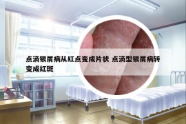 点滴银屑病从红点变成片状 点滴型银屑病转变成红斑