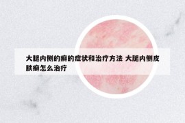 大腿内侧的癣的症状和治疗方法 大腿内侧皮肤癣怎么治疗