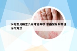 水疱型足癣怎么治才能除根 水疱型足癣最佳治疗方法