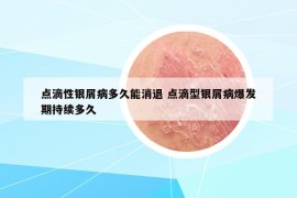 点滴性银屑病多久能消退 点滴型银屑病爆发期持续多久