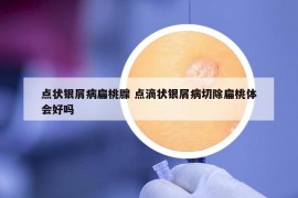 点状银屑病扁桃腺 点滴状银屑病切除扁桃体会好吗