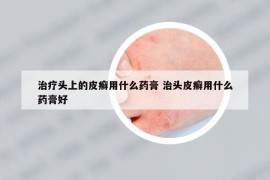 治疗头上的皮癣用什么药膏 治头皮癣用什么药膏好