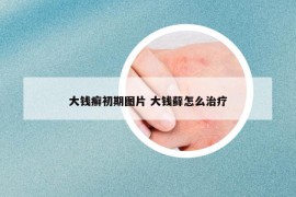 大钱癣初期图片 大钱藓怎么治疗