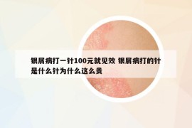 银屑病打一针100元就见效 银屑病打的针是什么针为什么这么贵