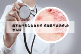 癣不治疗多久会自愈吗 癣如果不去治疗,会怎么样