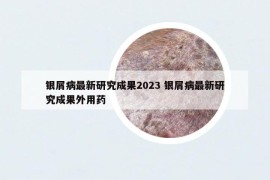 银屑病最新研究成果2023 银屑病最新研究成果外用药