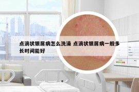 点滴状银屑病怎么洗澡 点滴状银屑病一般多长时间能好