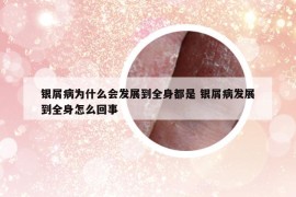 银屑病为什么会发展到全身都是 银屑病发展到全身怎么回事