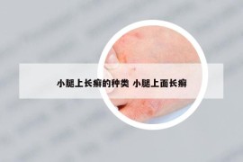 小腿上长癣的种类 小腿上面长癣