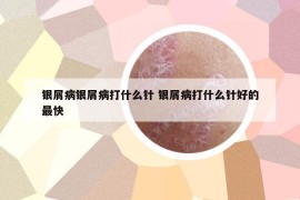 银屑病银屑病打什么针 银屑病打什么针好的最快