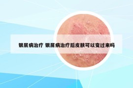 银屑病治疗 银屑病治疗后皮肤可以变过来吗