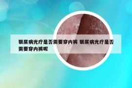 银屑病光疗是否需要穿内裤 银屑病光疗是否需要穿内裤呢