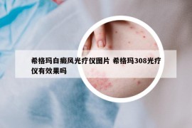 希格玛白癜风光疗仪图片 希格玛308光疗仪有效果吗