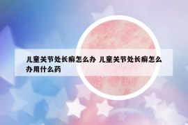 儿童关节处长癣怎么办 儿童关节处长癣怎么办用什么药