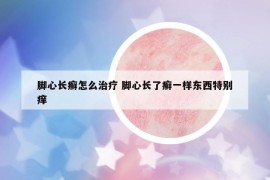 脚心长癣怎么治疗 脚心长了癣一样东西特别痒