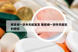 银屑病一到冬天就复发 银屑病一到冬天就犯的原因