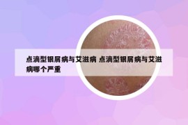 点滴型银屑病与艾滋病 点滴型银屑病与艾滋病哪个严重