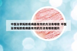 中医治掌跖脓疱病最有效的方法有哪些 中医治掌跖脓疱病最有效的方法有哪些图片