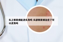 头上银屑病能烫头发吗 头部银屑病治愈了可以烫发吗