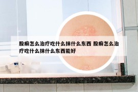 股癣怎么治疗吃什么抹什么东西 股癣怎么治疗吃什么抹什么东西能好