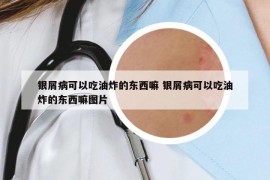 银屑病可以吃油炸的东西嘛 银屑病可以吃油炸的东西嘛图片