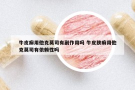 牛皮癣用他克莫司有副作用吗 牛皮肤癣用他克莫司有依赖性吗