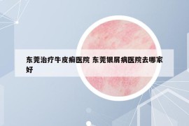 东莞治疗牛皮癣医院 东莞银屑病医院去哪家好