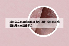 成都公立银屑病医院哪家可以治 成都银屑病医院是公立还是私立