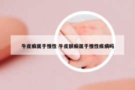 牛皮癣属于慢性 牛皮肤癣属于慢性疾病吗