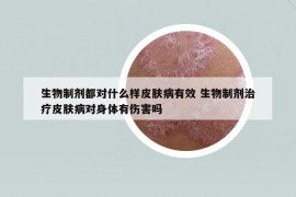 生物制剂都对什么样皮肤病有效 生物制剂治疗皮肤病对身体有伤害吗