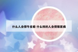 什么人会得牛皮癣 什么样的人会得银屑病