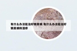 有什么办法能治好银屑病 有什么办法能治好银屑病和湿疹