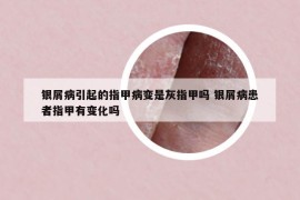 银屑病引起的指甲病变是灰指甲吗 银屑病患者指甲有变化吗