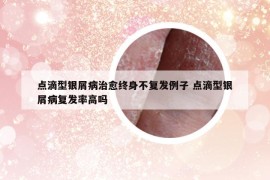 点滴型银屑病治愈终身不复发例子 点滴型银屑病复发率高吗