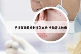 手指背面起癣刺挠怎么治 手指背上长癣