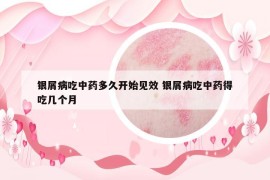 银屑病吃中药多久开始见效 银屑病吃中药得吃几个月