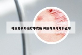 神应养真丹治疗牛皮癣 神应养真丹外科正宗