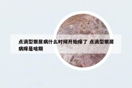 点滴型银屑病什么时候开始痒了 点滴型银屑病痒是啥期