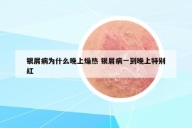 银屑病为什么晚上燥热 银屑病一到晚上特别红