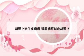 胡萝卜治牛皮癣吗 银屑病可以吃胡萝卜