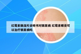 红霉素肠溶片说明书对银屑病 红霉素眼膏可以治疗银屑病吗