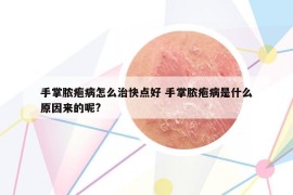 手掌脓疱病怎么治快点好 手掌脓疱病是什么原因来的呢?