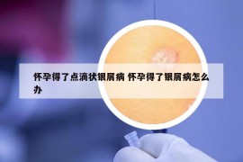 怀孕得了点滴状银屑病 怀孕得了银屑病怎么办