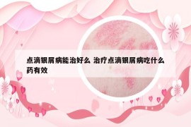 点滴银屑病能治好么 治疗点滴银屑病吃什么药有效